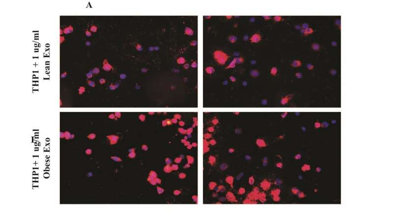 来自人类脂肪细胞的microrna可以削弱巨噬细胞消除胆固醇的能力