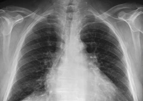 MIMIC chest X-ray database to provide researchers access to over 350,000 patient radiographs