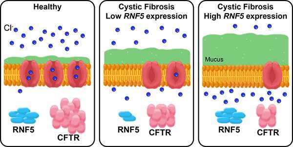 Modifier gene may explain why some with cystic fibrosis are less prone to infection
