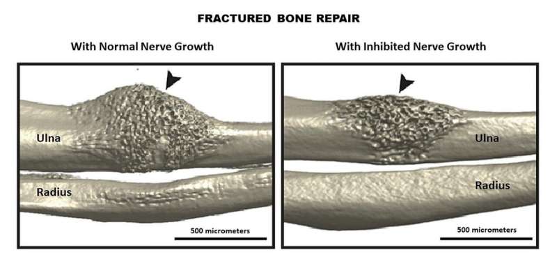Mouse study shows nerve signaling pathway critical to healing fractures