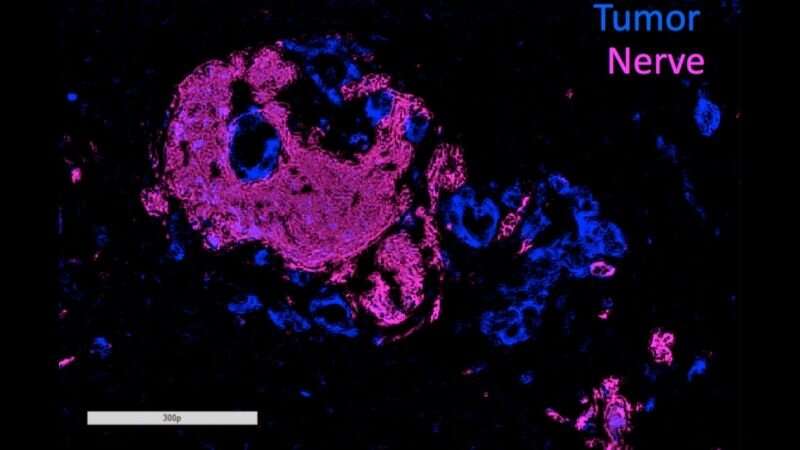 Nerves could be key to pancreatic cancer spread