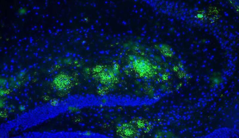 New compound shows promise in treatment of Alzheimer’s