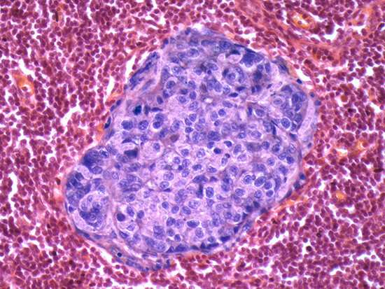 New review identifies four hallmarks of cancer metastasis