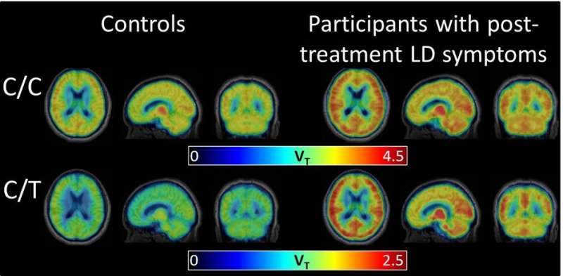 新的扫描技术揭示了治疗后莱姆病综合征相关的脑炎症