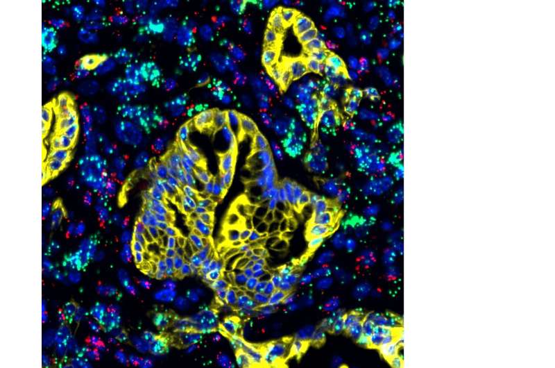 New study targets Achilles' heel of pancreatic cancer, with promising results