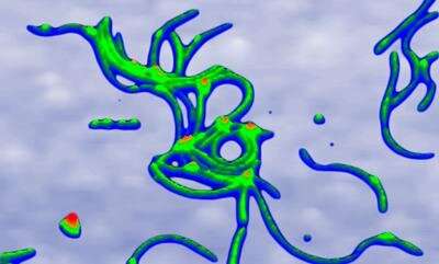 New way to identify and track progression of Huntington’s disease