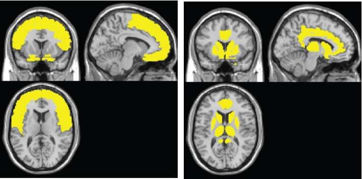 Novel brain map tracks early brain atrophy from HIV infection