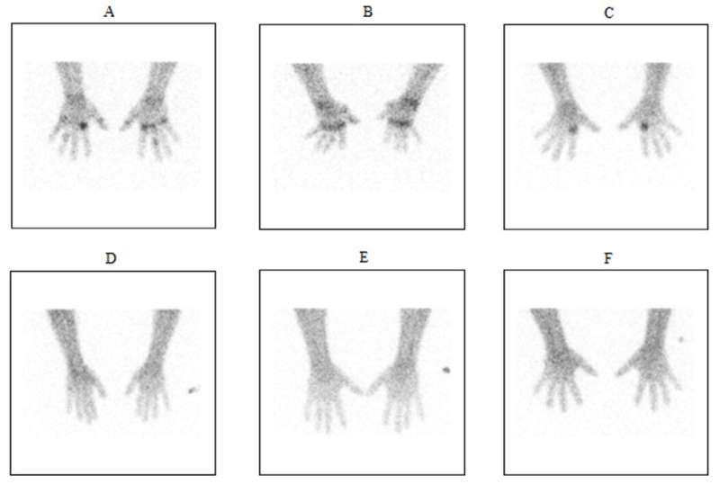 Novel noninvasive molecular imaging for monitoring rheumatoid arthritis