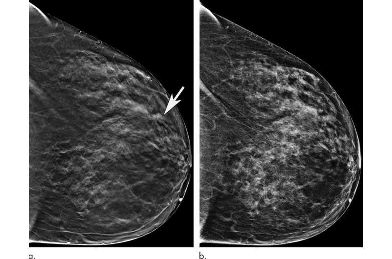 老年女性在接受3D乳房x光检查时获益显著