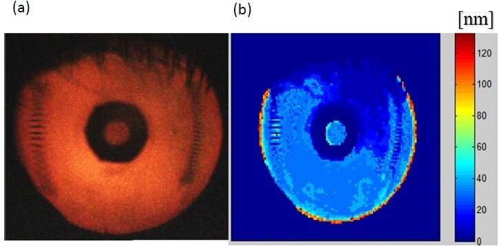 Optical imager poised to improve diagnosis and treatment of dry eye disease