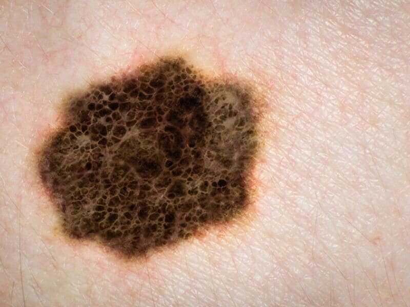 Overall survival worse with multiple primary melanomas