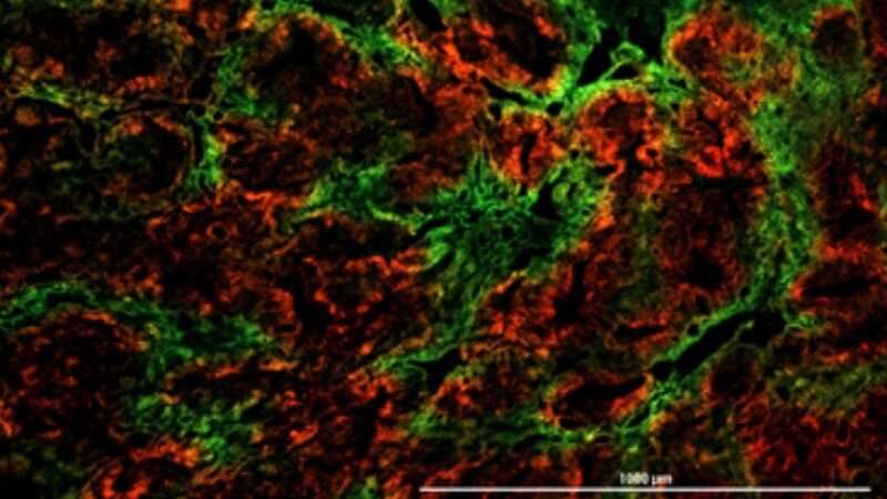 Oxygen-starved tumor cells have survival advantage that promotes cancer spread