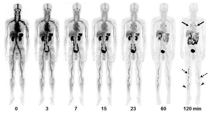 PET/CT imaging agent shows promise for better diagnosis of acute venous thromboembolism