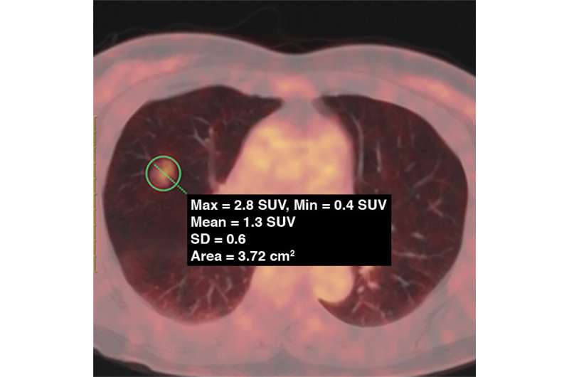PET/CT plays role in lung adenocarcinoma management