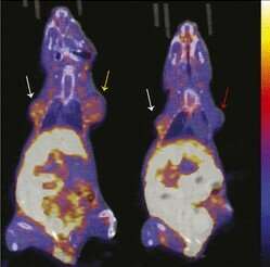 PET imaging agent may allow early measurement of efficacy of breast cancer therapy