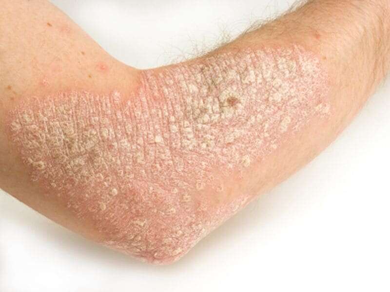 Psoriasis tied to high BMI, low meat intake in japanese study