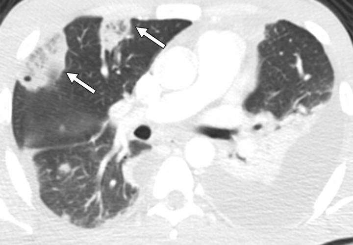 Reversed halo signs manifest in septic pulmonary embolism due to IV drug use