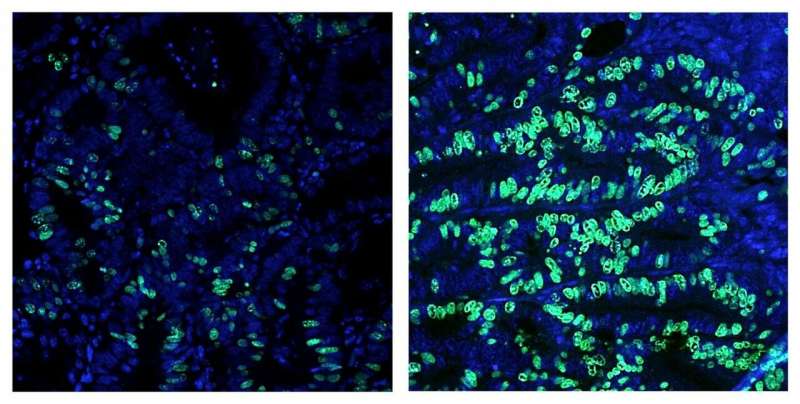 Salk scientists uncover how high-fat diet drives colorectal cancer growth
