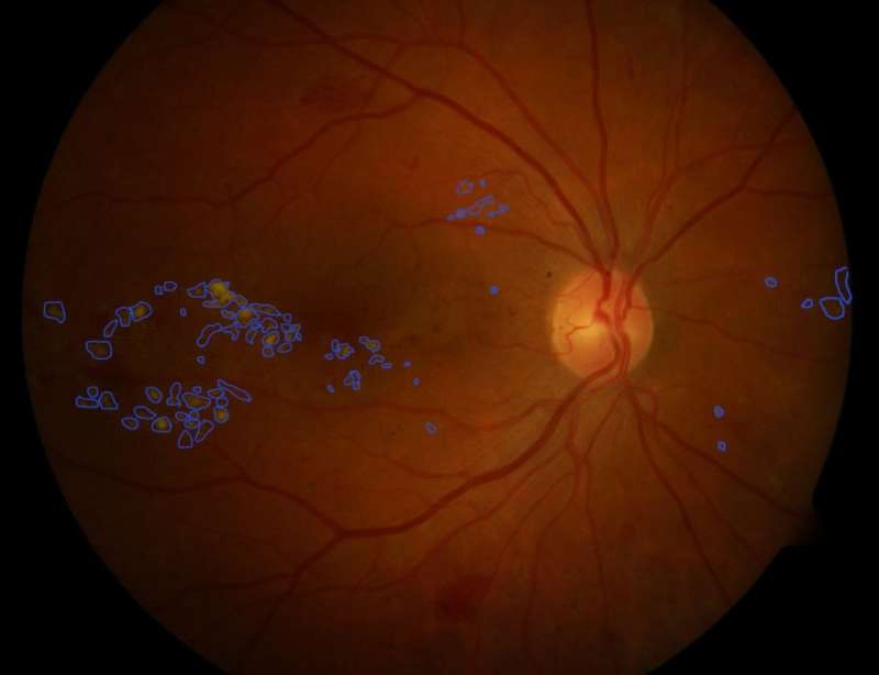 Saving sight: Using AI to diagnose diabetic eye disease