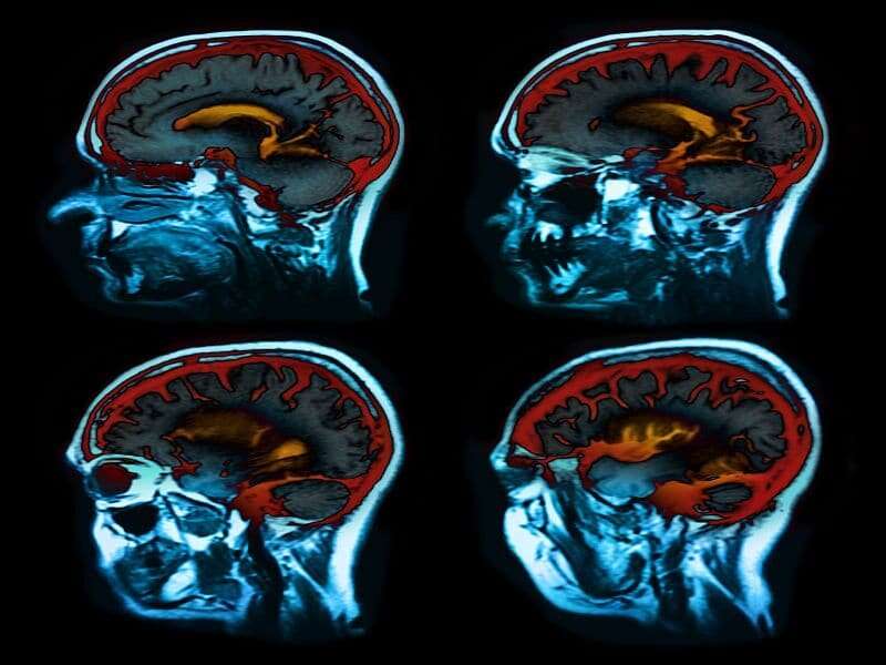 Serum biomarker linked to brain atrophy in multiple sclerosis