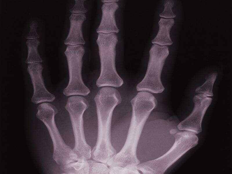Serum IL-35 levels tied to bone loss with rheumatoid arthritis