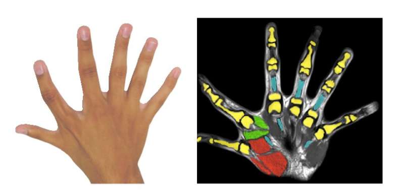 Six fingers per hand