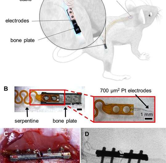**Smart bone plates can monitor fracture healing
