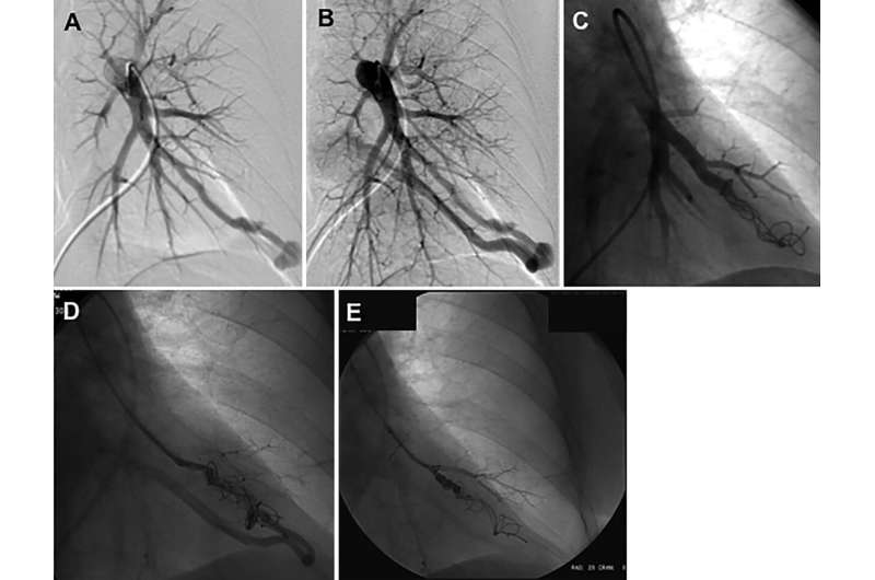 Smoking impedes embolization treatment in lungs