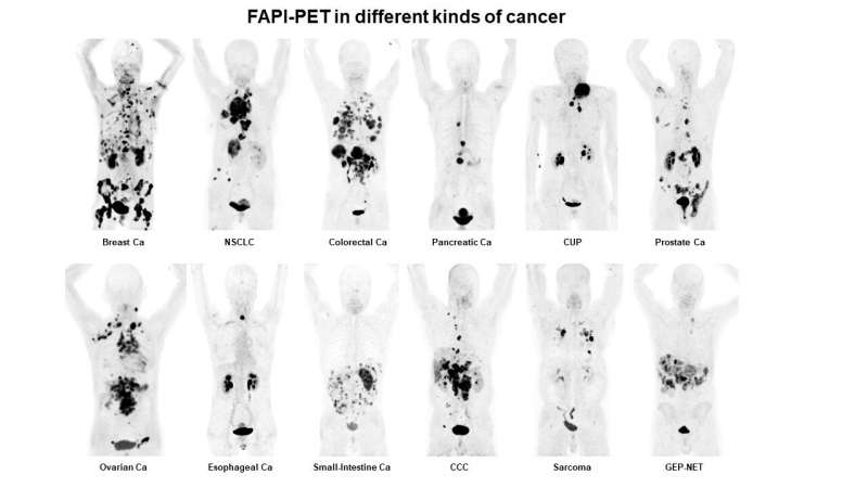 SNMMI Image of the Year: Novel radiotracer detects 28 cancer types