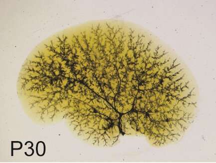 SOX9在Alagille综合征中重塑胆汁树