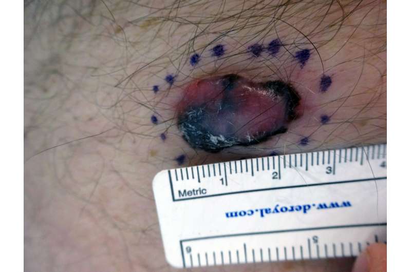 States with fewer melanoma diagnoses have higher death rates
