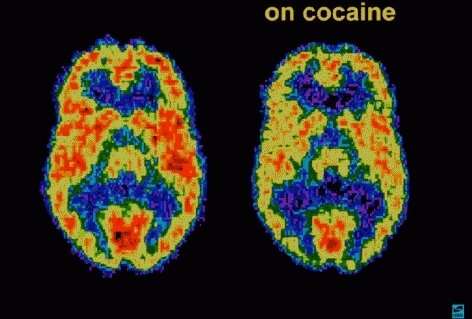 Study may help prevent relapse in cocaine use disorder patients
