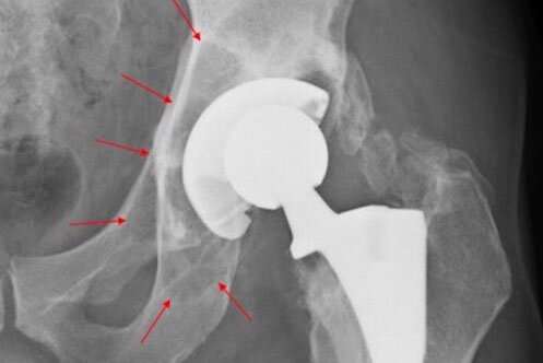 Study uncovers cause of bone loss in joint implant patients