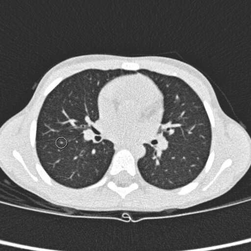 Suspicious spots on the lungs do not behave like metastases of rhabdomyosarcoma