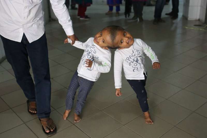 The twins, named Rabeya and Rukaya, had their skulls and brains successfully separated in a marathon 30-hour operation carried o