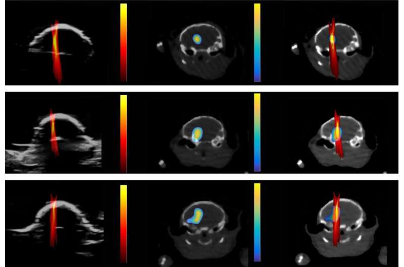 Ultrasound imaging can monitor the exact drug dose and delivery site in the brain