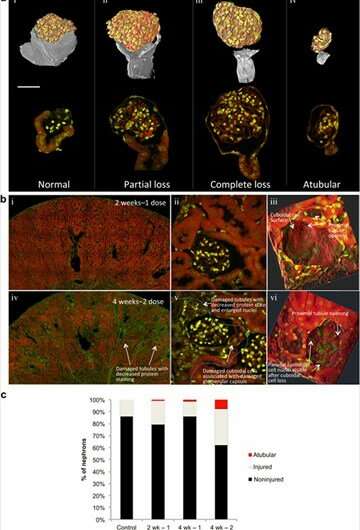 Unresolved injury, not fibrosis, contributes to cisplatin-induced CKD