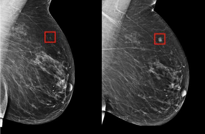 Using AI to predict breast cancer and personalize care