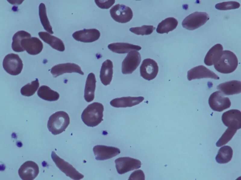 Voxelotor improves hemoglobin levels in sickle cell disease