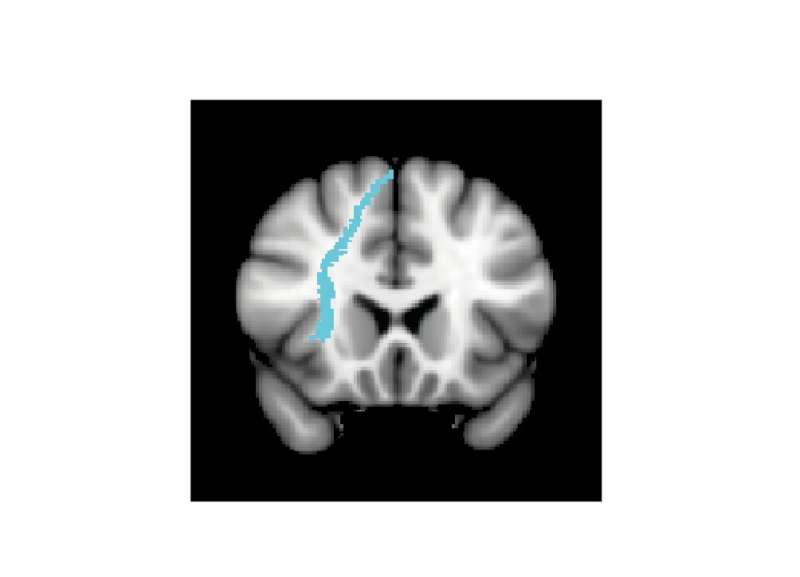 White matter affects how people respond to brain stimulation therapy