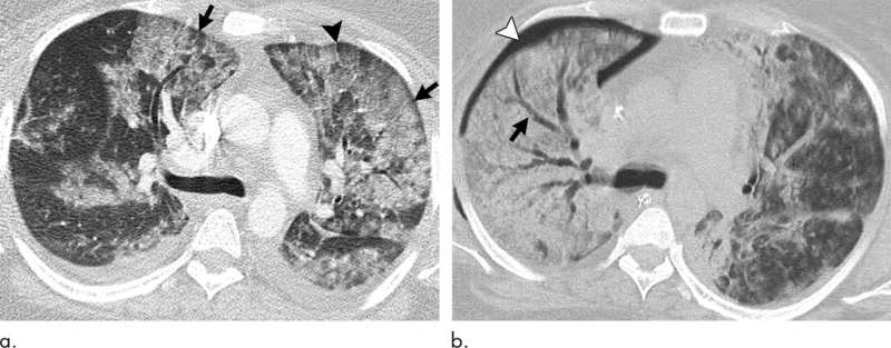 Abnormal imaging findings key to EVALI diagnosis in vapers