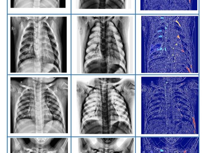 AI auto-scans lung X-rays for coronavirus