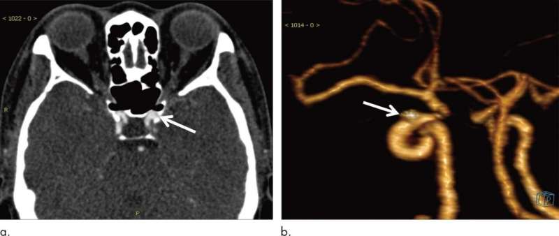AI helps detect brain aneurysms on CT angiography
