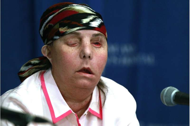A US first, New Hampshire woman gets second face transplant