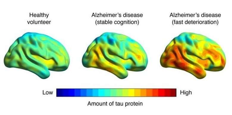 Brain deterioration in Alzheimer's disease 