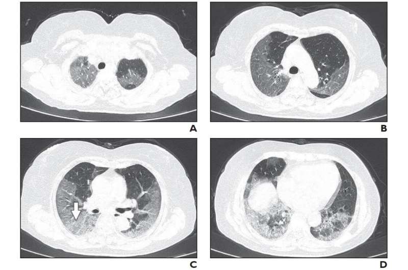 Chinese researchers detail chest CT findings in coronavirus disease (COVID-19) pneumonia