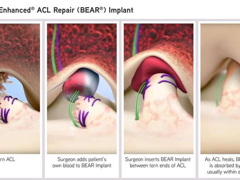 FDA authorizes marketing of ACL implant