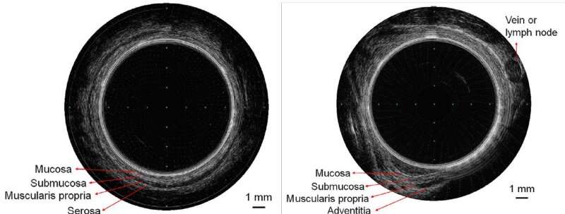 Finger-size ultrasound capsule endoscopy for effective high-resolution imaging