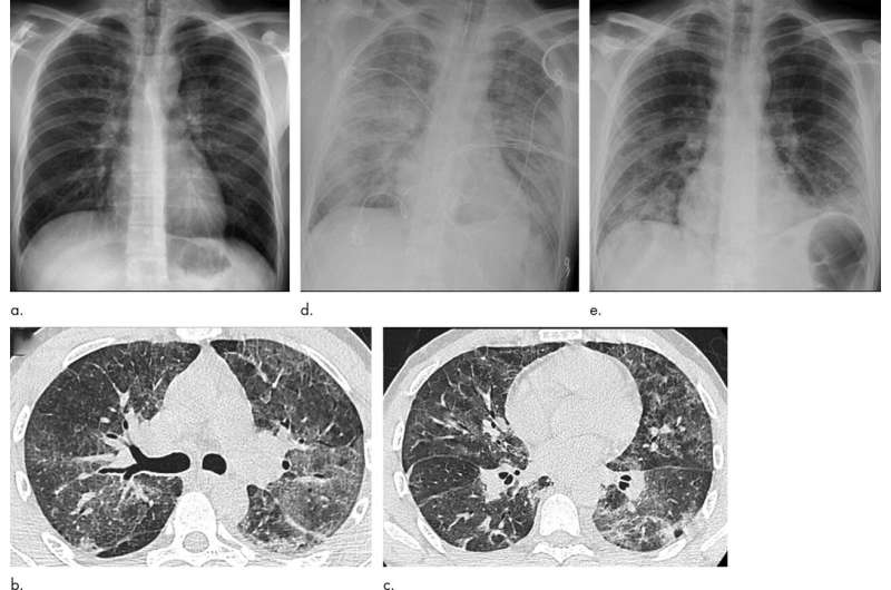 Lung injuries from vaping have characteristic patterns on CT