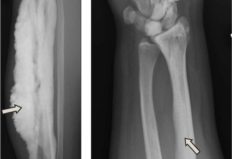 NIH researchers discover gene for rare disease of excess bone tissue growth